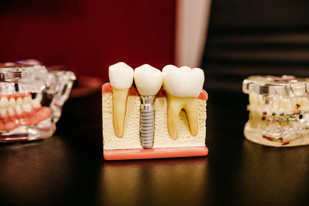 front dental implants