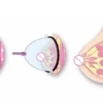 breast enlargement pump