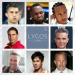 Celebrities Hair Transplant