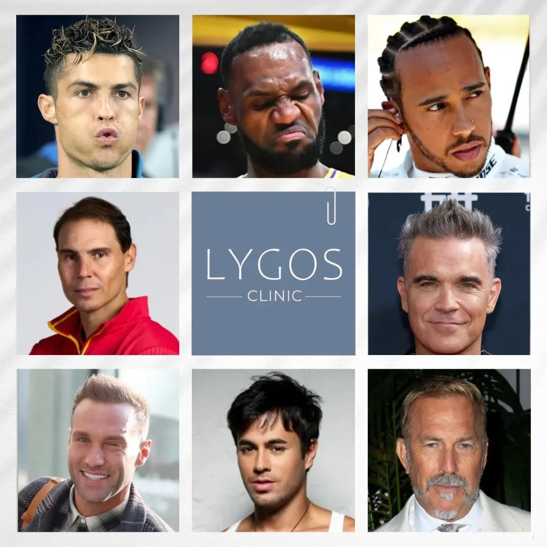 Celebrities Hair Transplant