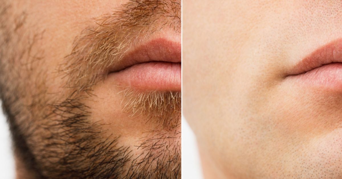 LASER HAIR REMOVAL