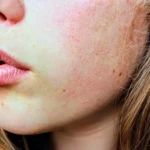 Healthy Skin
