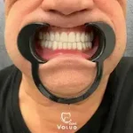 Mouth Dental Implants