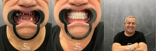 Mouth Dental Implants