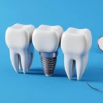 Dental implants