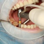How Dental Implants Can Transform Your Life