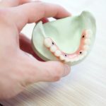 How Technological Advancements Are Revolutionizing Dental Implants