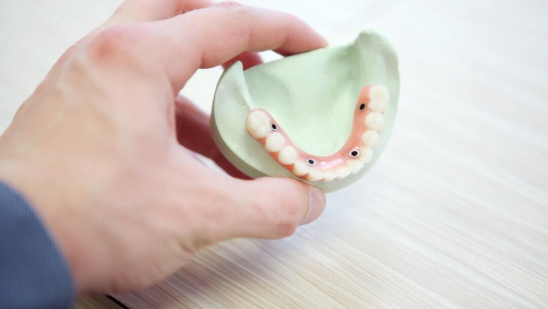How Technological Advancements Are Revolutionizing Dental Implants