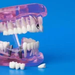 Dental implant surgery