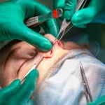 Nose Surgery