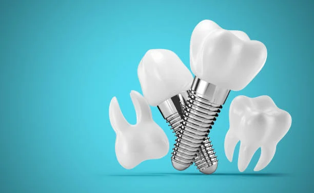 Dental Implants
