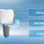 Dental Implants in Arlington