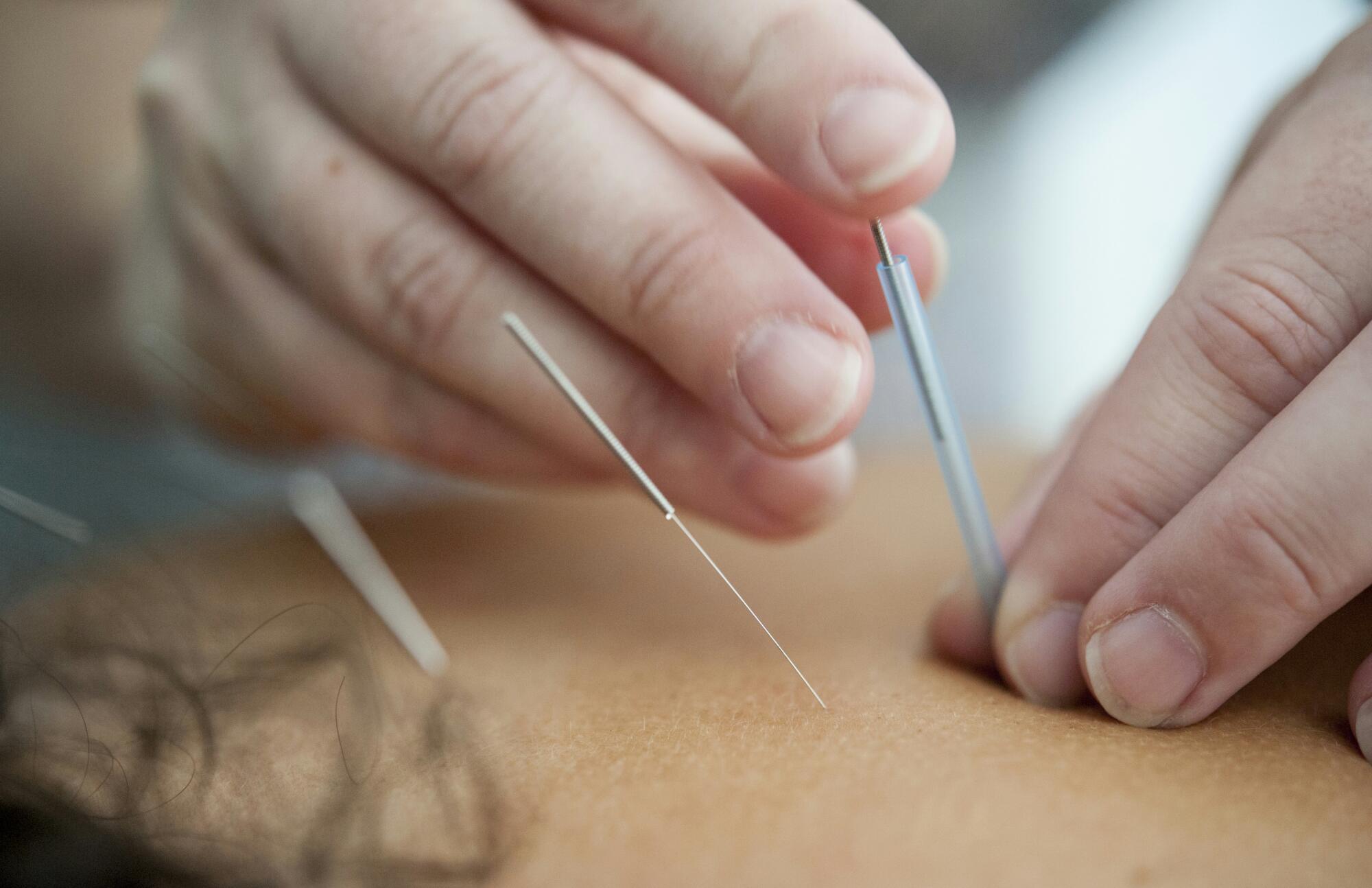 How Acupuncture Complements Modern Lifestyle Practices