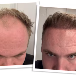 Hair Transplant