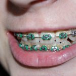 Dental Braces 101: Types, Costs, and Treatment Options