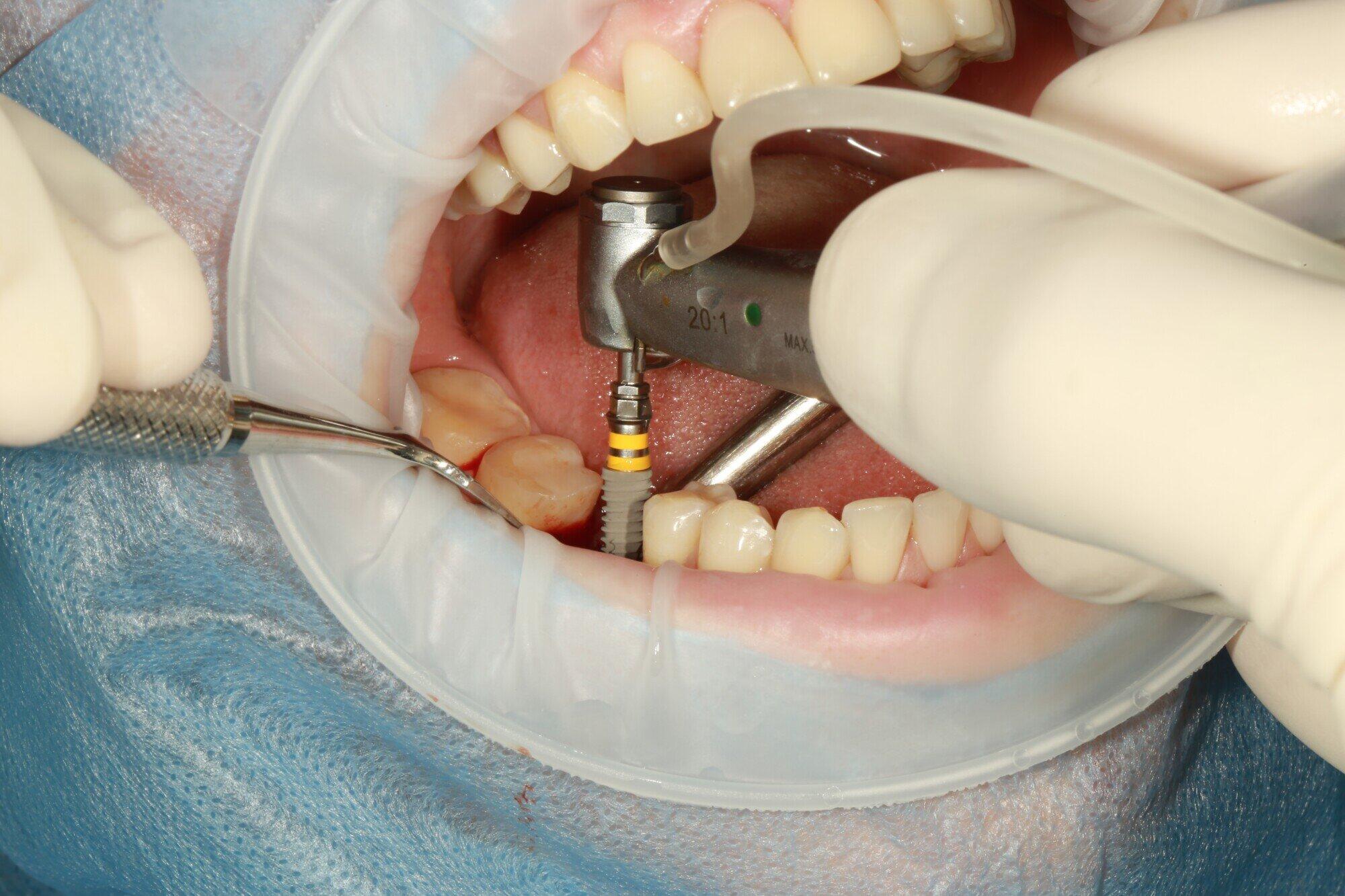 The Evolution of Dental Implants: A Modern Solution