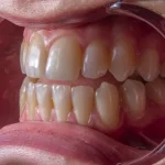 Teeth Discoloration