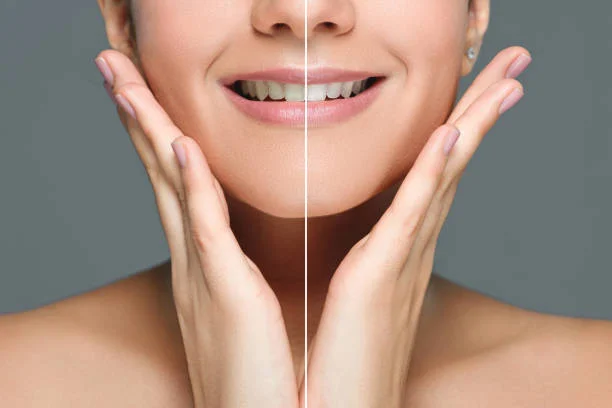 Before and after results of BrassSmile cosmetic dentistry smile makeover treatment 2026
